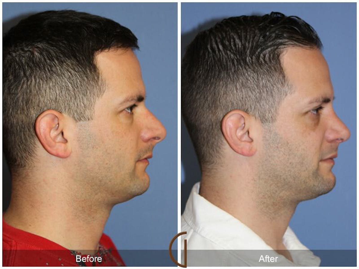 Rhinoplasty Before & After Gallery - Patient 860117 - Image 3