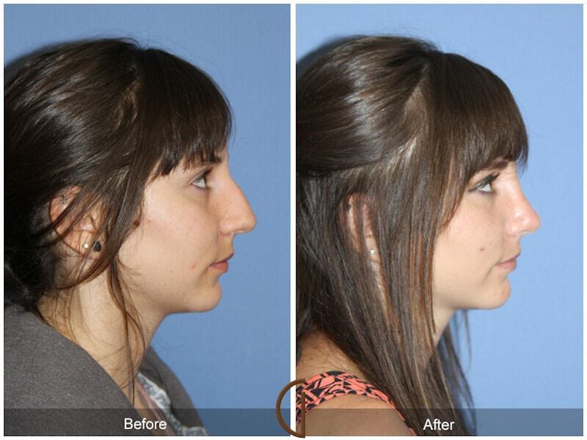 Female Rhinoplasty Before & After Gallery - Patient 298285 - Image 3