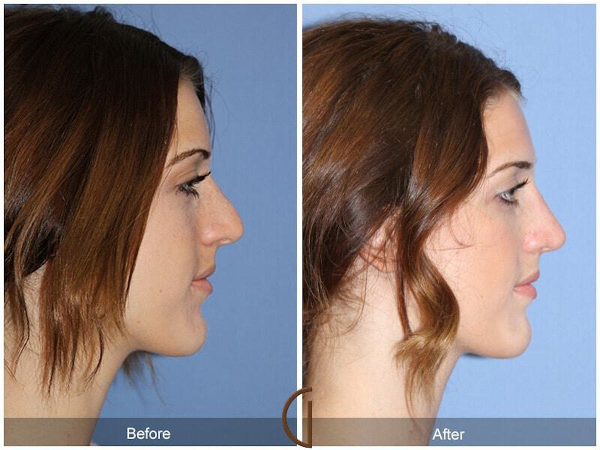 Female Rhinoplasty Before & After Gallery - Patient 180016 - Image 3