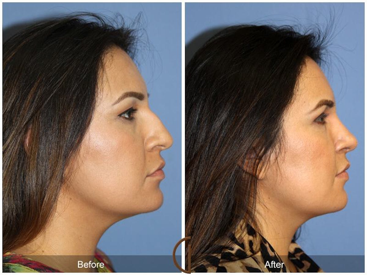 Female Rhinoplasty Before & After Gallery - Patient 197646 - Image 3