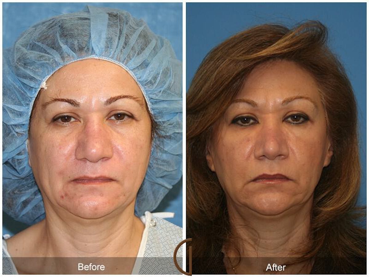 Revision Rhinoplasty Before & After Gallery - Patient 269959 - Image 2