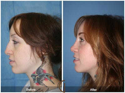 Revision Rhinoplasty Before & After Gallery - Patient 104074 - Image 1