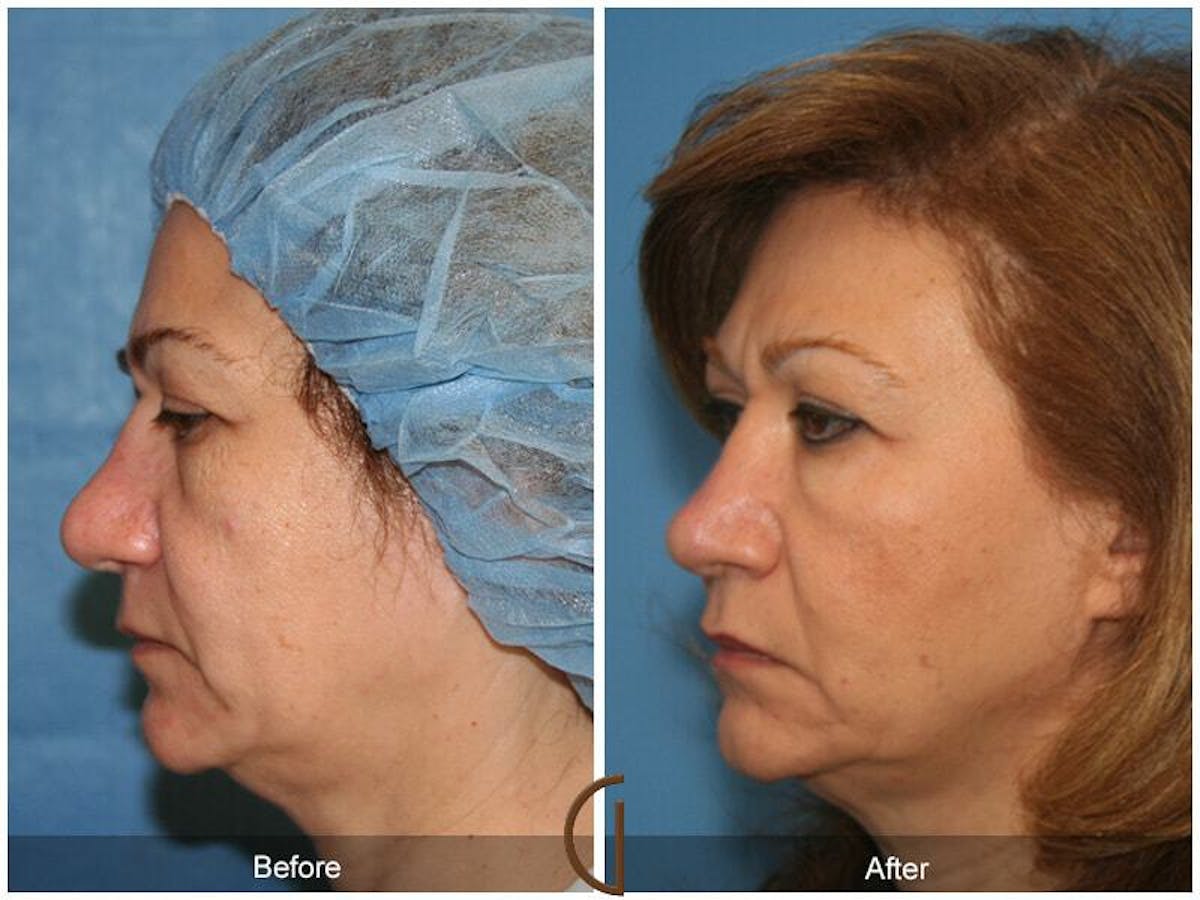 Revision Rhinoplasty Before & After Gallery - Patient 269959 - Image 1