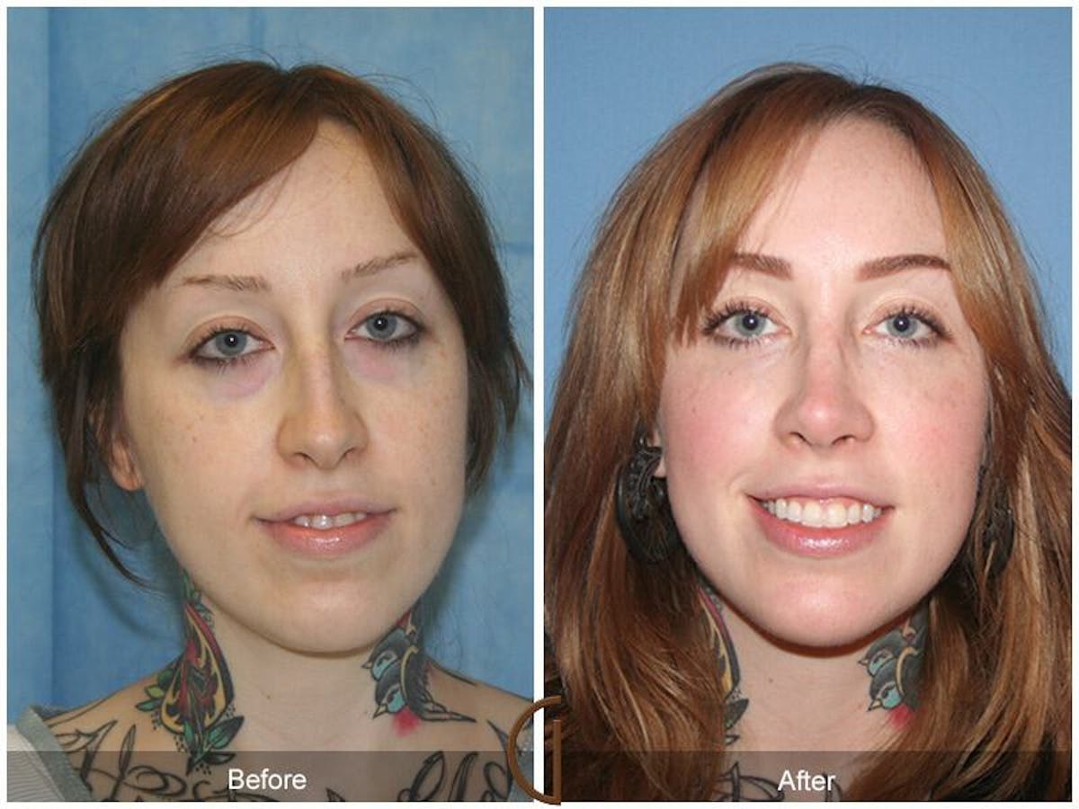 Revision Rhinoplasty Before & After Gallery - Patient 104074 - Image 2