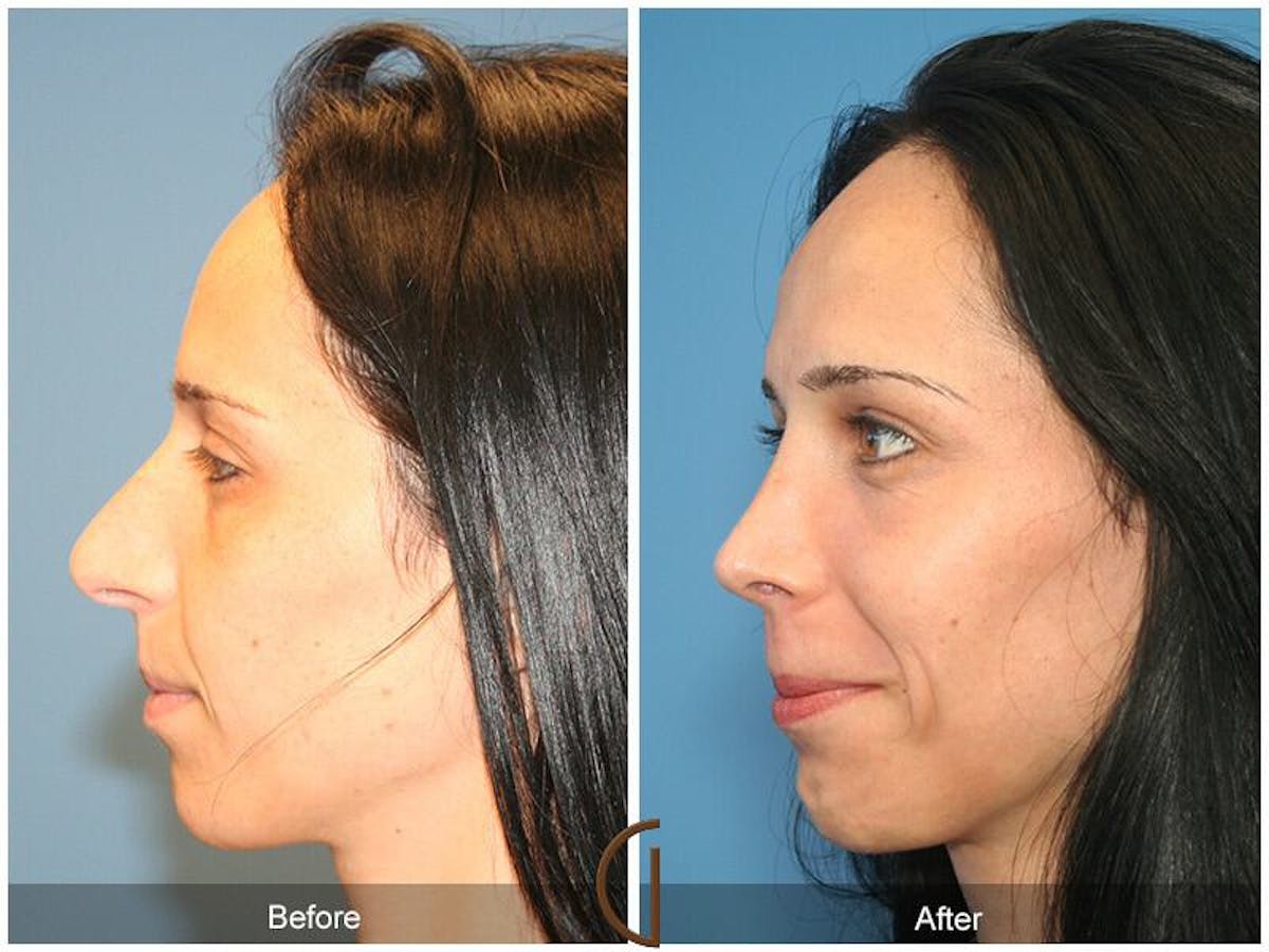 Female Rhinoplasty Before & After Gallery - Patient 328114 - Image 1