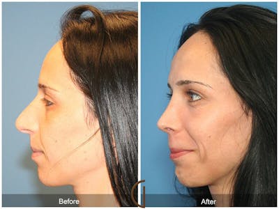 Female Rhinoplasty Before & After Gallery - Patient 328114 - Image 1