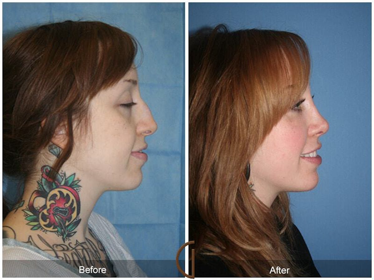 Revision Rhinoplasty Before & After Gallery - Patient 104074 - Image 3