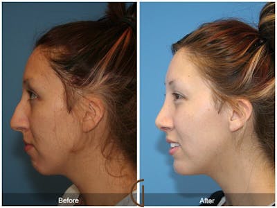 Female Rhinoplasty Before & After Gallery - Patient 164419 - Image 1