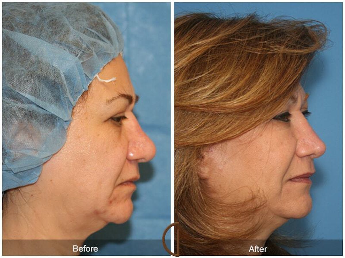 Revision Rhinoplasty Before & After Gallery - Patient 269959 - Image 3