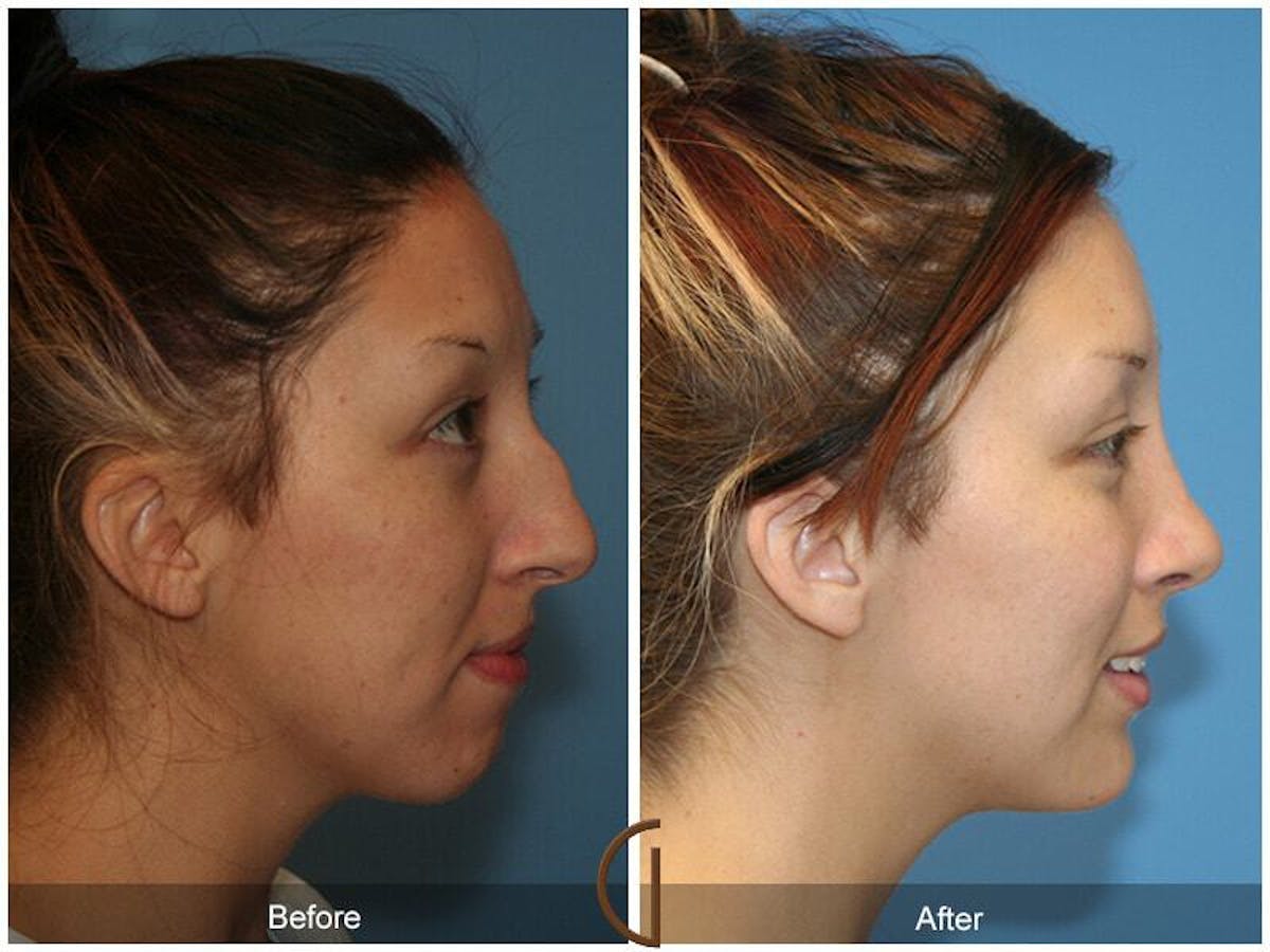Female Rhinoplasty Before & After Gallery - Patient 164419 - Image 3