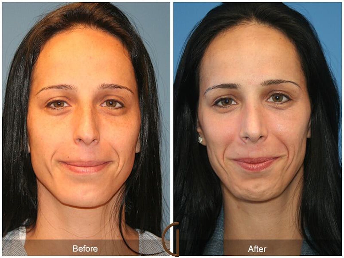 Female Rhinoplasty Before & After Gallery - Patient 328114 - Image 2