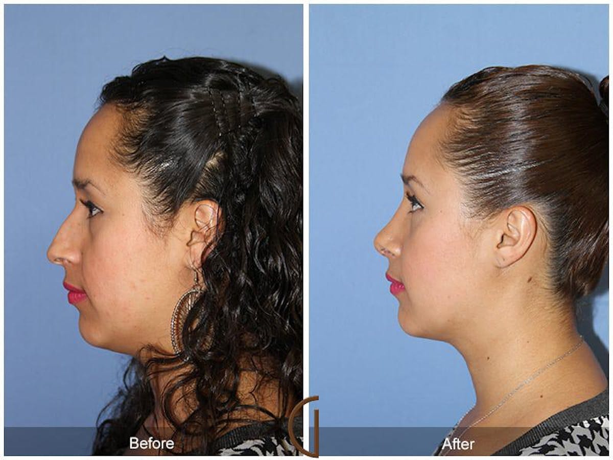 Ethnic Rhinoplasty Before & After Gallery - Patient 278137 - Image 1