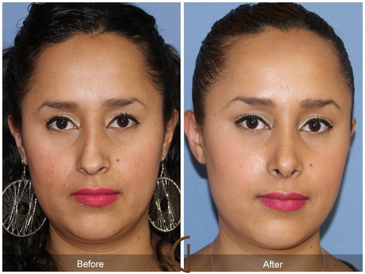 Ethnic Rhinoplasty Before & After Gallery - Patient 278137 - Image 2