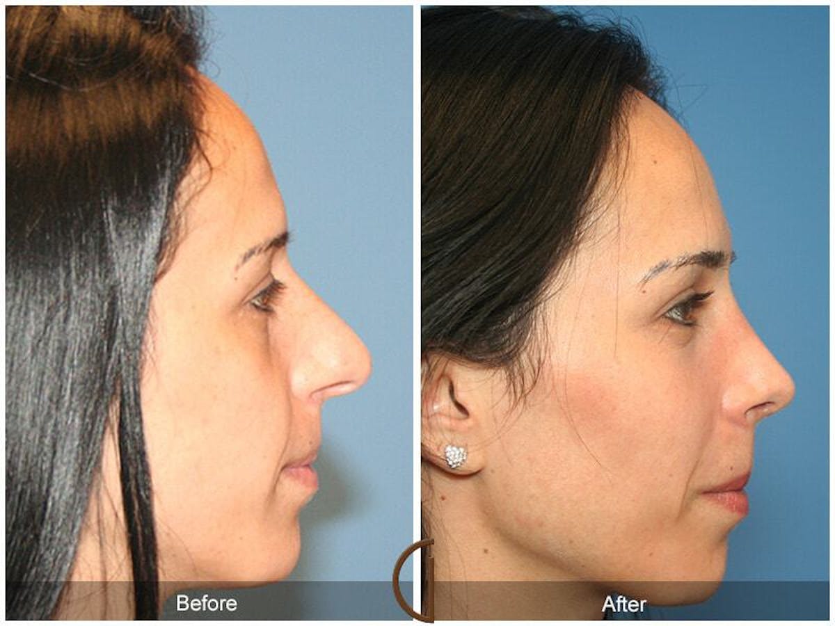 Female Rhinoplasty Before & After Gallery - Patient 328114 - Image 3
