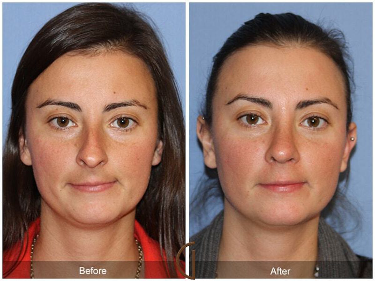 Female Rhinoplasty Before & After Gallery - Patient 137840 - Image 2