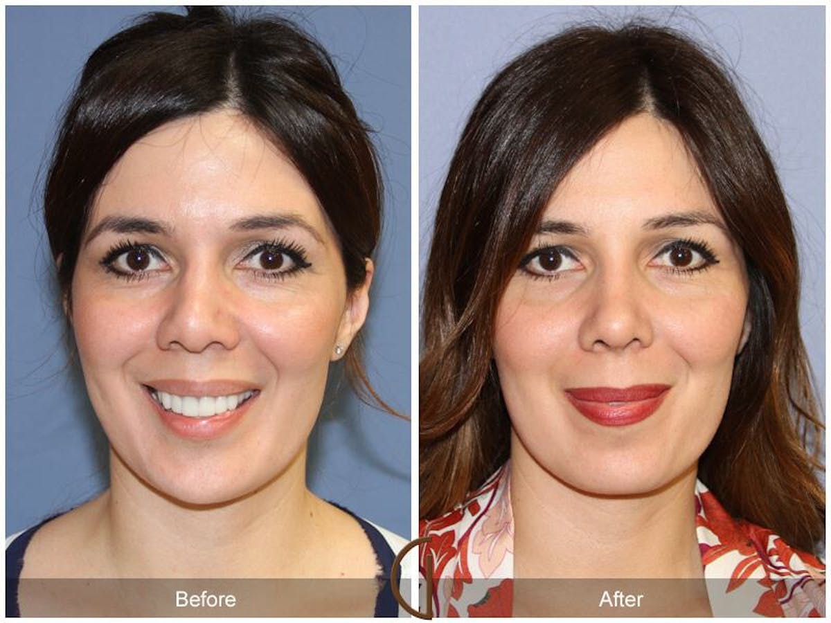 Female Rhinoplasty Before & After Gallery - Patient 353335 - Image 2
