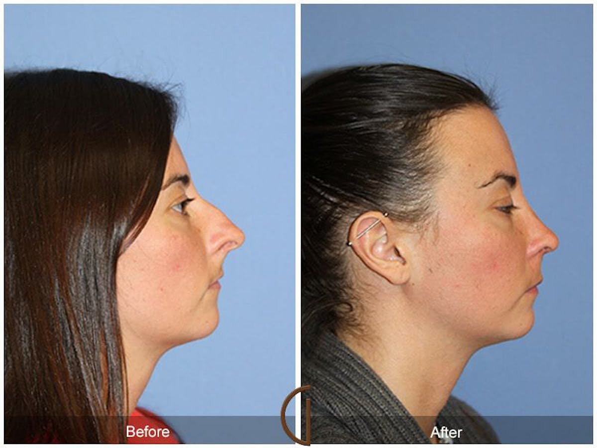 Female Rhinoplasty Before & After Gallery - Patient 137840 - Image 3