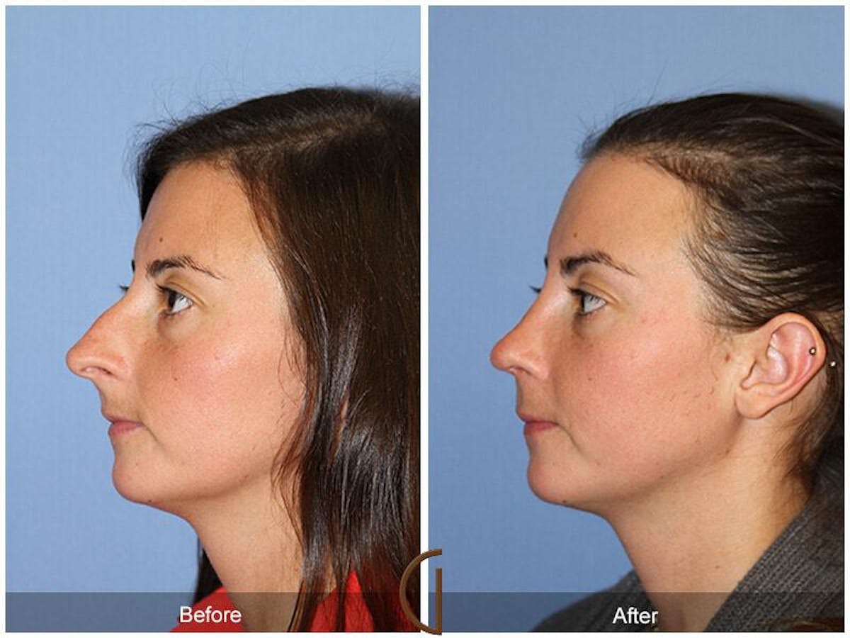 Female Rhinoplasty Before & After Gallery - Patient 137840 - Image 1