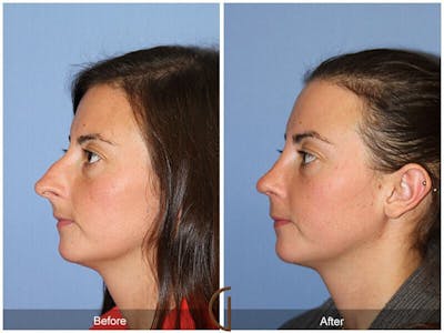 Female Rhinoplasty Before & After Gallery - Patient 137840 - Image 1