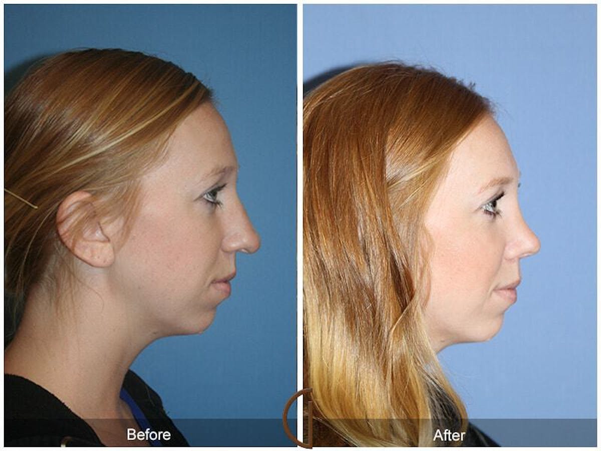 Female Rhinoplasty Before & After Gallery - Patient 387213 - Image 3