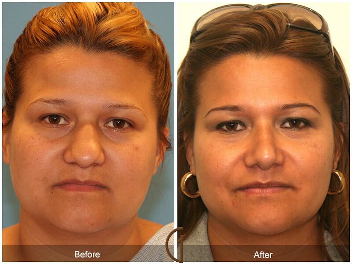Rhinoplasty Before & After Gallery - Patient 339652 - Image 2