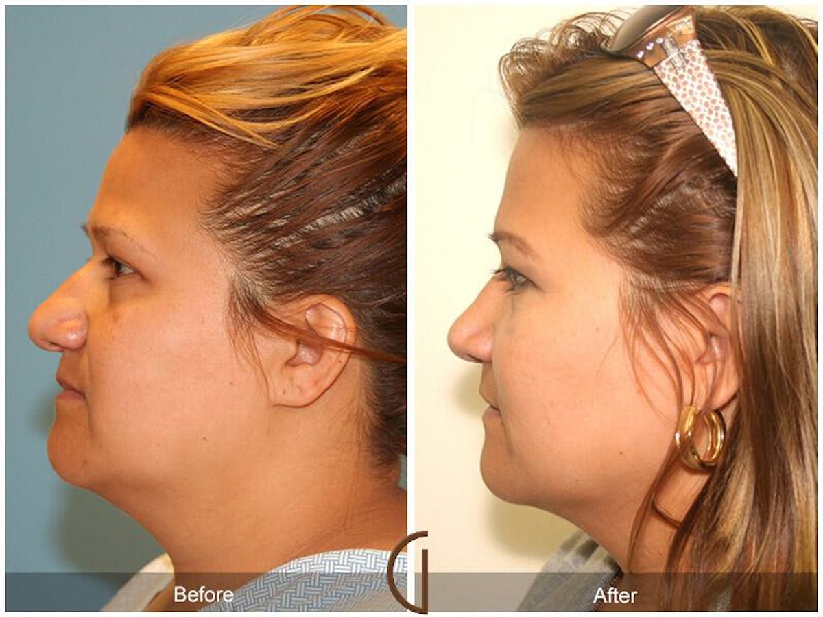 Rhinoplasty Before & After Gallery - Patient 339652 - Image 1