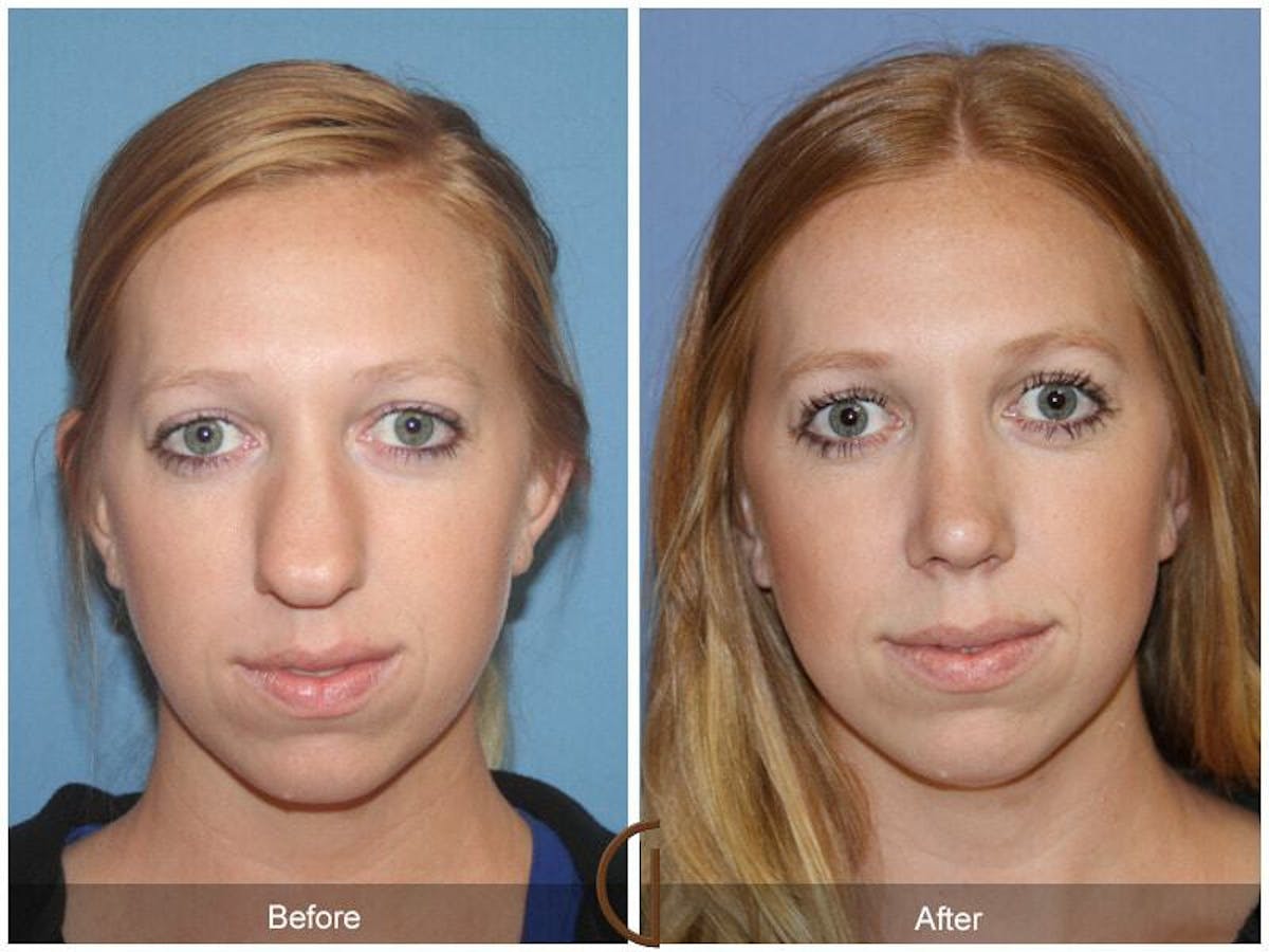 Female Rhinoplasty Before & After Gallery - Patient 387213 - Image 2