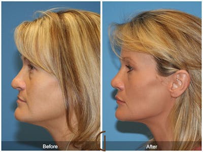 Revision Rhinoplasty Before & After Gallery - Patient 339953 - Image 1