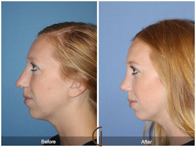 Female Rhinoplasty Before & After Gallery - Patient 387213 - Image 1