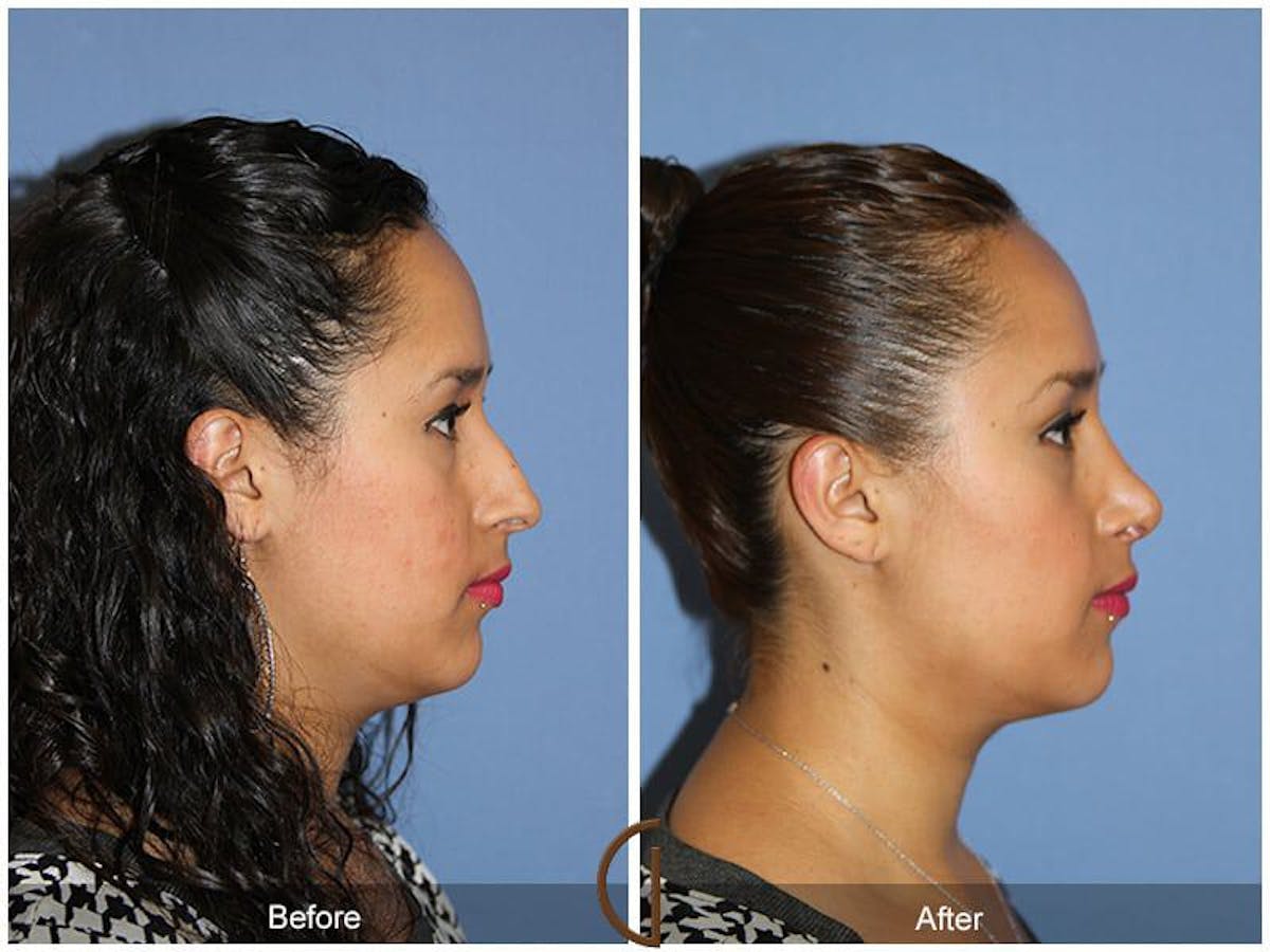 Ethnic Rhinoplasty Before & After Gallery - Patient 278137 - Image 3