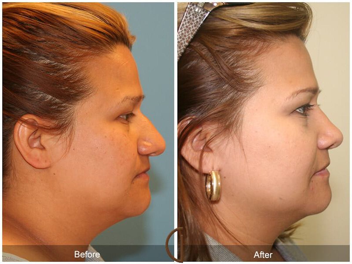 Rhinoplasty Before & After Gallery - Patient 339652 - Image 3