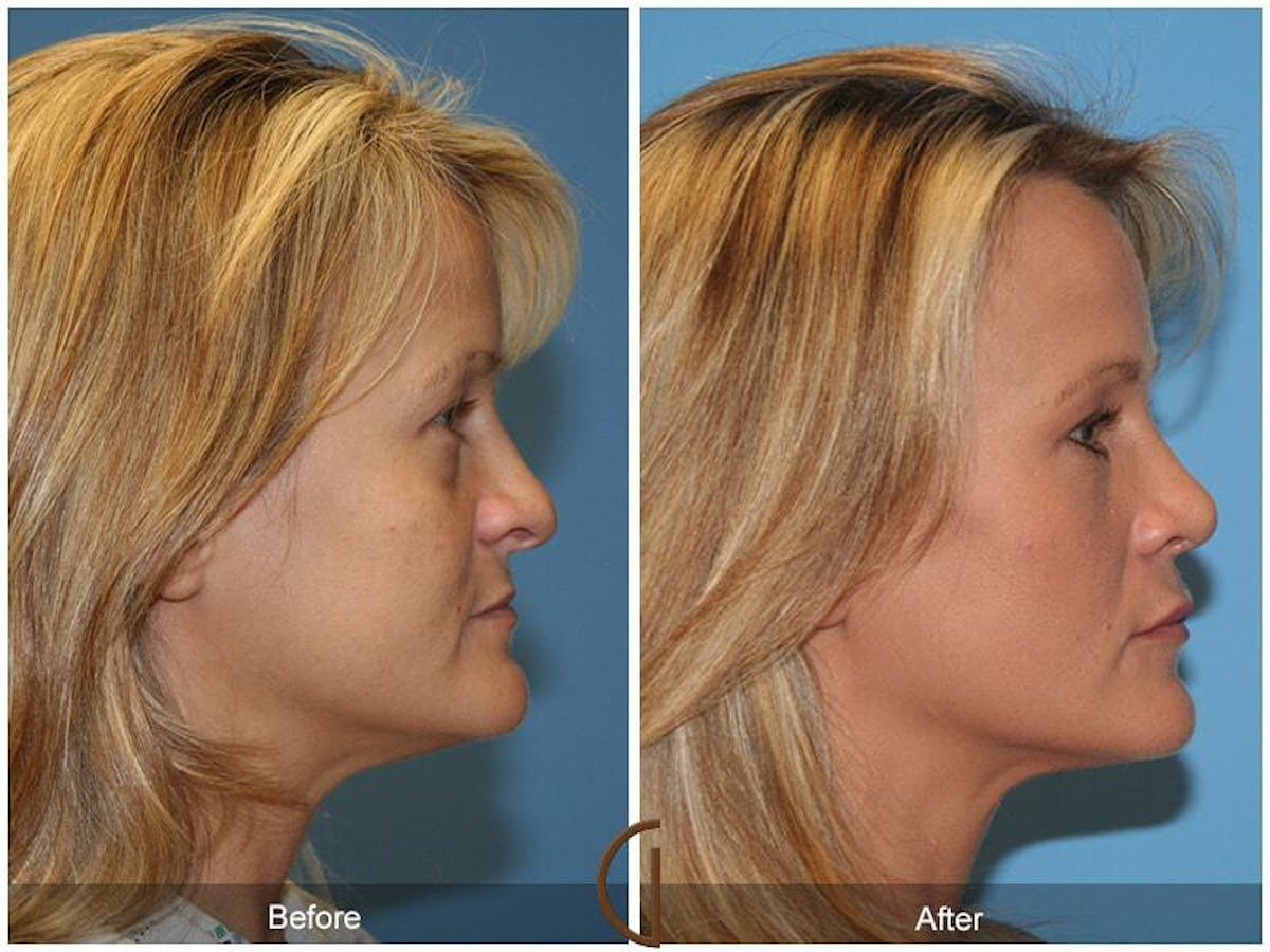 Revision Rhinoplasty Before & After Gallery - Patient 339953 - Image 3