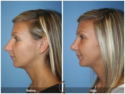 Female Rhinoplasty Before & After Gallery - Patient 483868 - Image 1