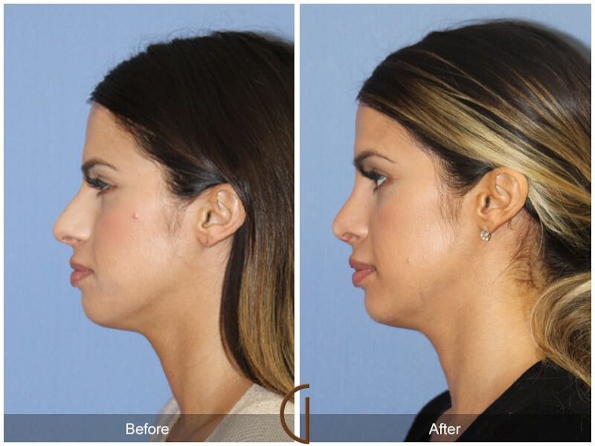 Female Rhinoplasty Before & After Gallery - Patient 117952 - Image 1