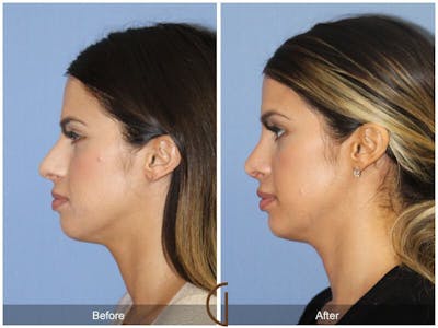 Female Rhinoplasty Before & After Gallery - Patient 117952 - Image 1