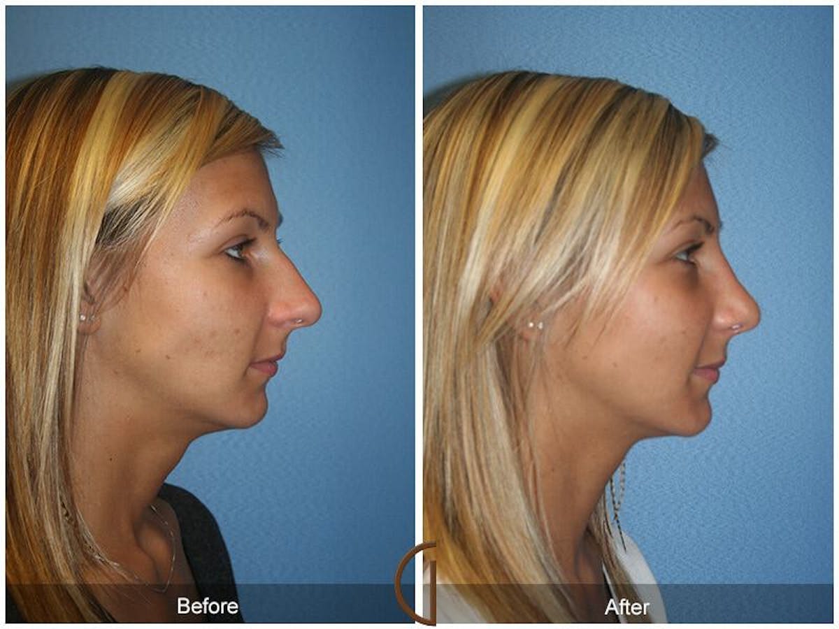 Female Rhinoplasty Before & After Gallery - Patient 483868 - Image 3