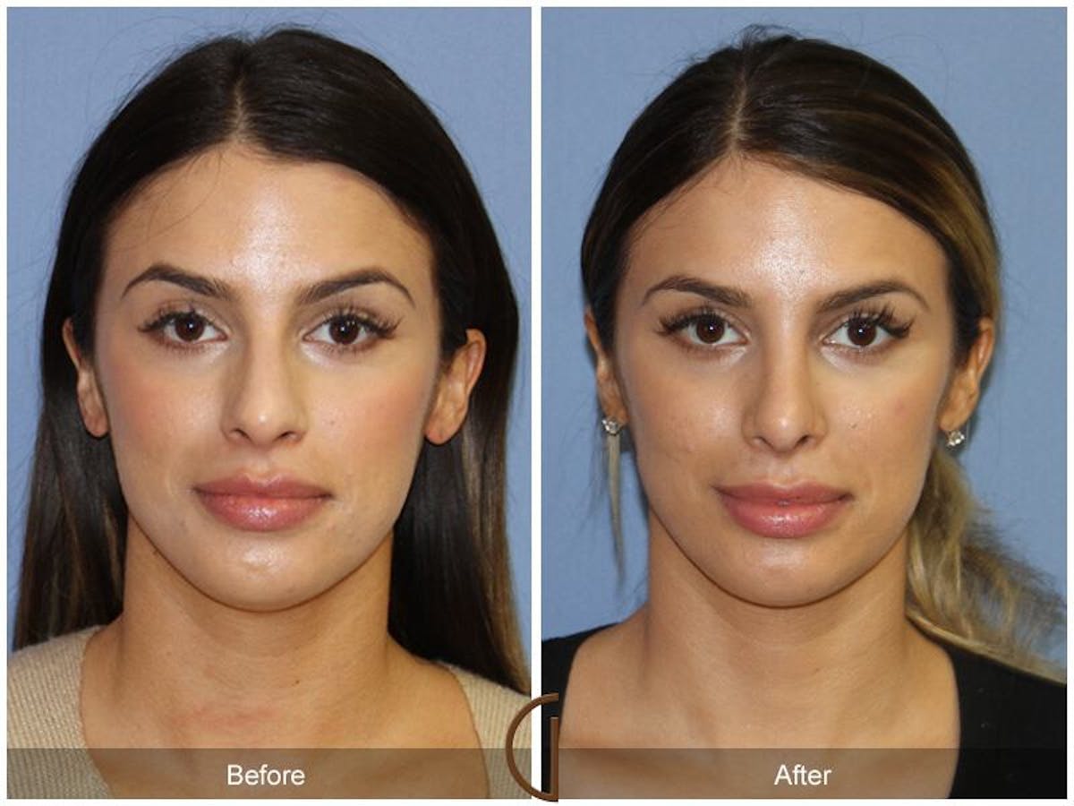 Female Rhinoplasty Before & After Gallery - Patient 117952 - Image 2