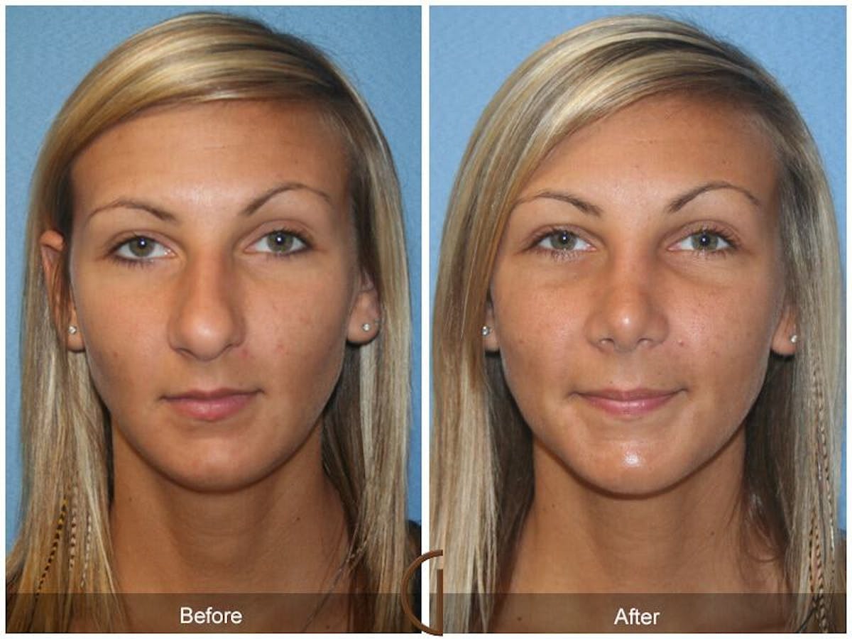 Female Rhinoplasty Before & After Gallery - Patient 483868 - Image 2