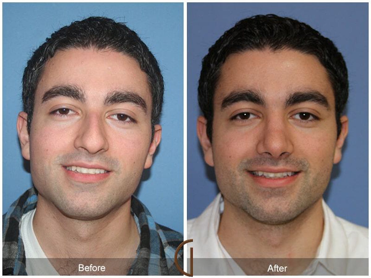Male Rhinoplasty Before & After Gallery - Patient 119059 - Image 2