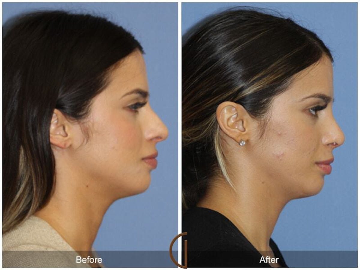 Female Rhinoplasty Before & After Gallery - Patient 117952 - Image 3