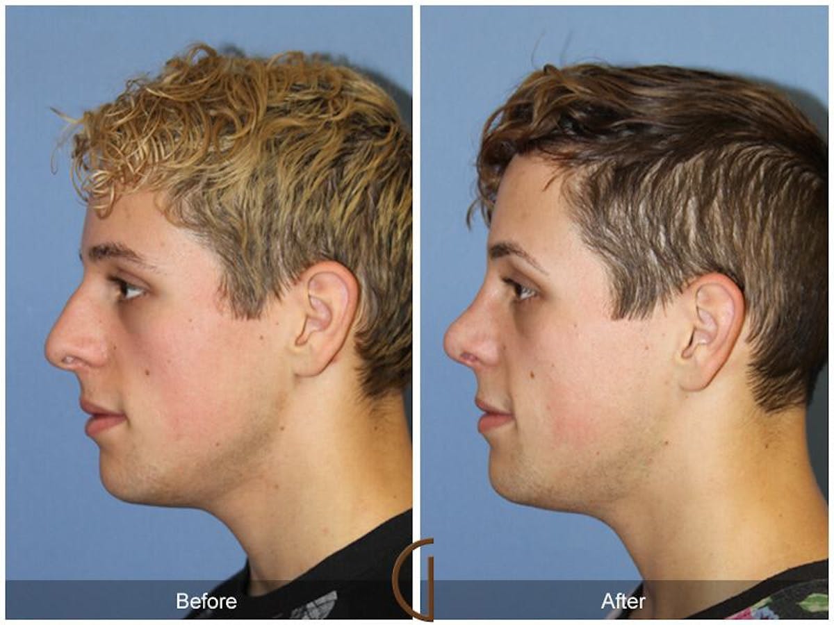 Rhinoplasty Before & After Gallery - Patient 694020 - Image 1