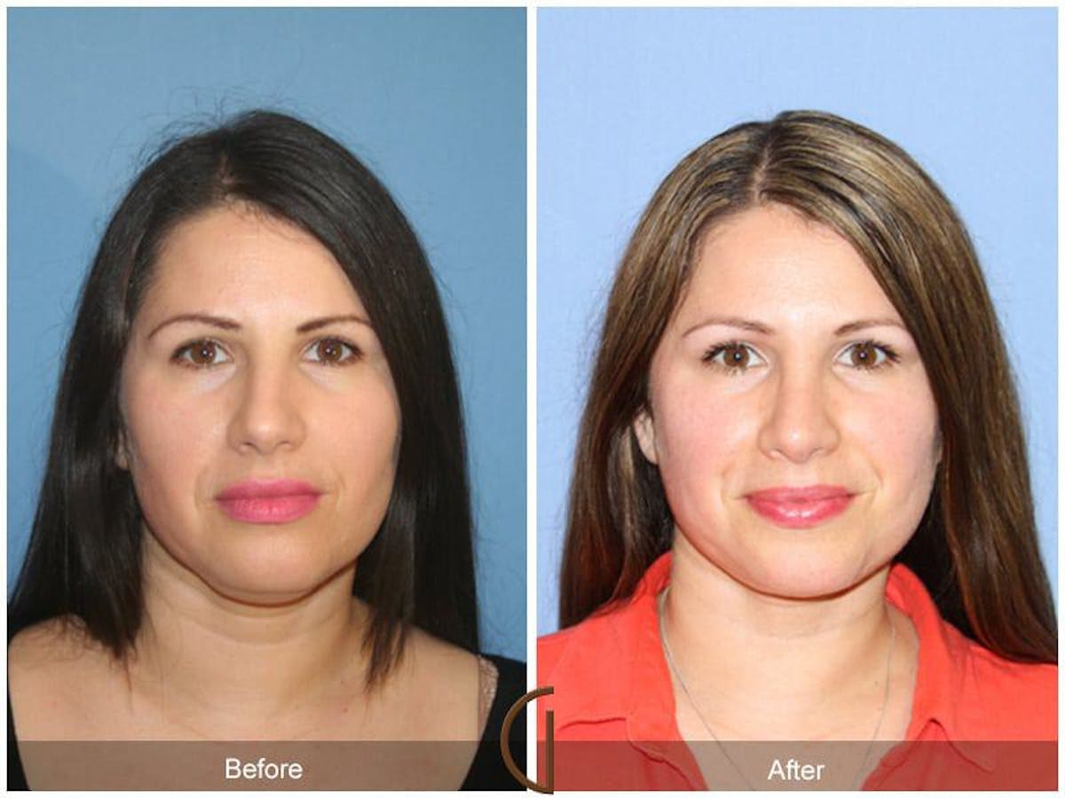Revision Rhinoplasty Before & After Gallery - Patient 340724 - Image 2