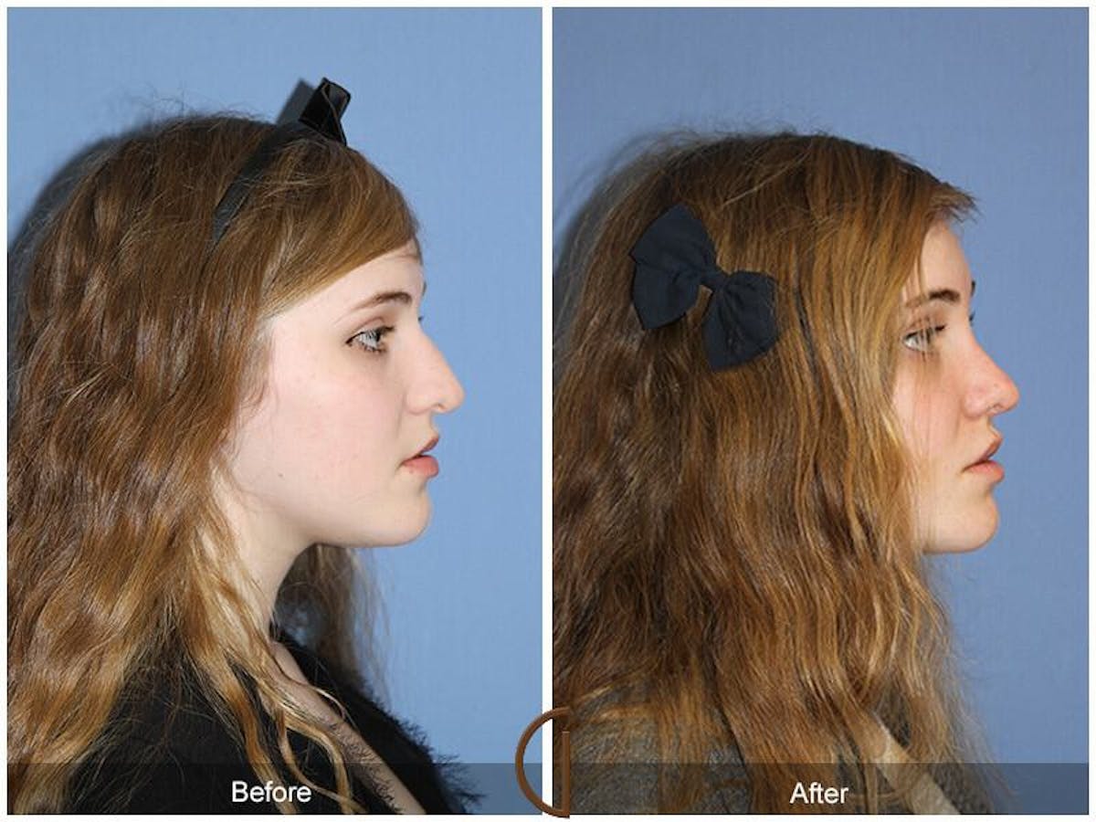 Female Rhinoplasty Before & After Gallery - Patient 222482 - Image 3