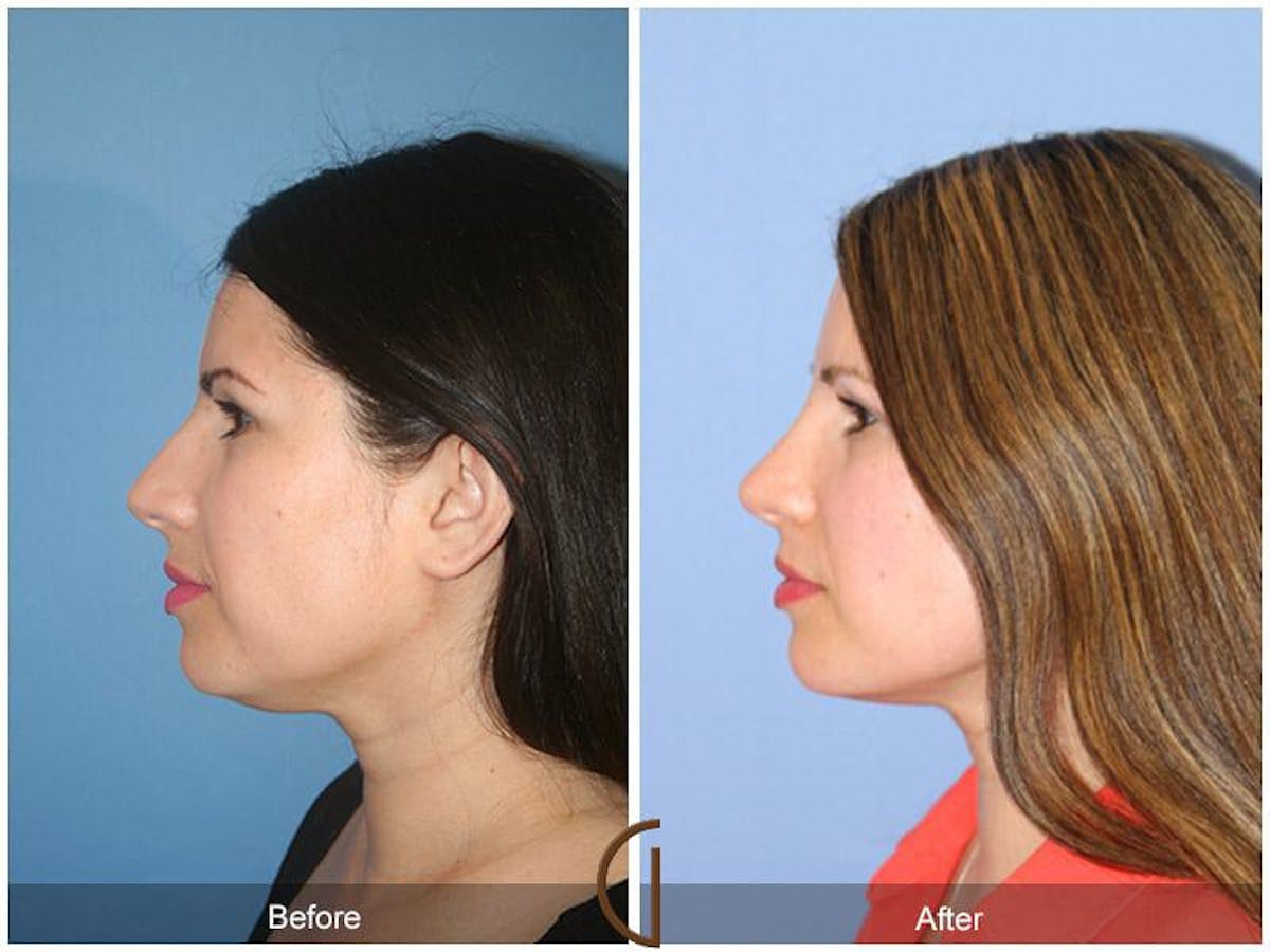 Revision Rhinoplasty Before & After Gallery - Patient 340724 - Image 1