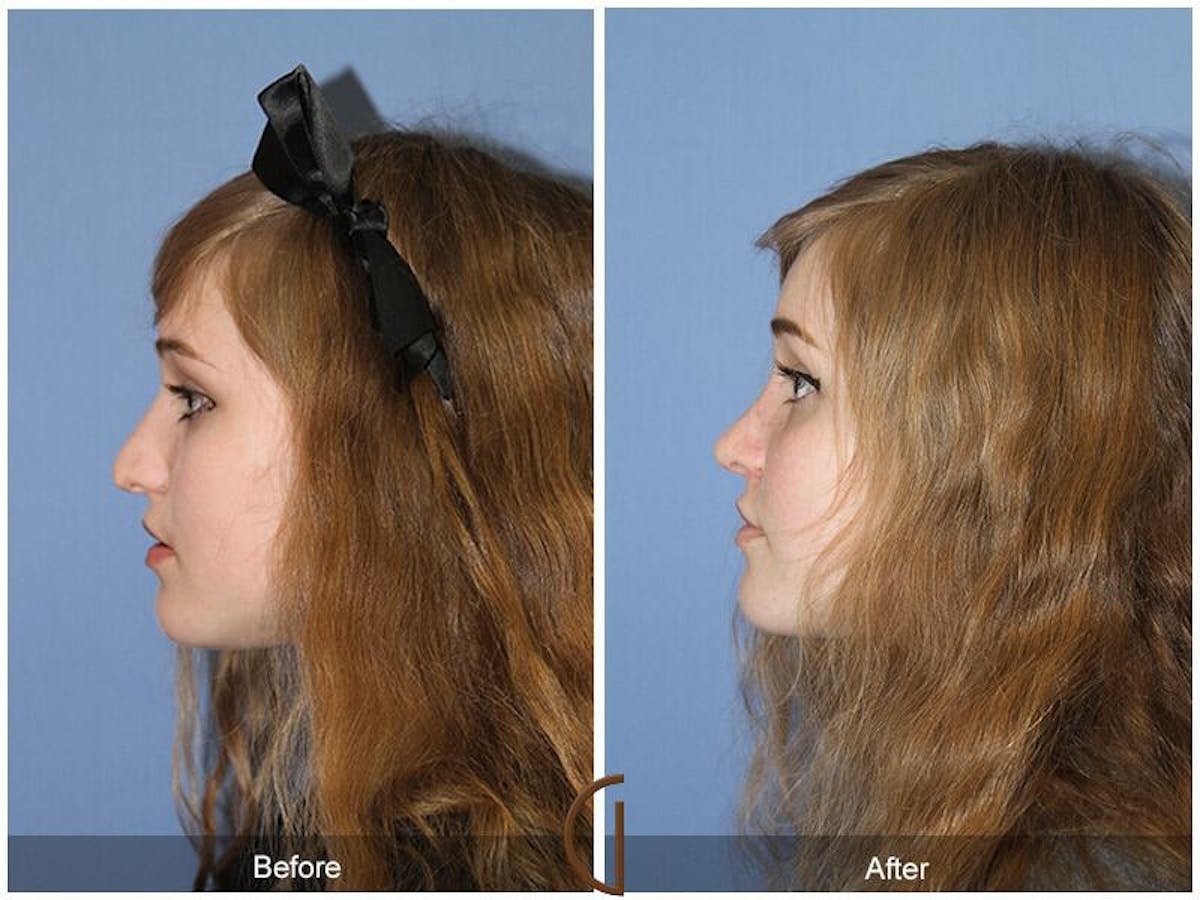 Female Rhinoplasty Before & After Gallery - Patient 222482 - Image 1
