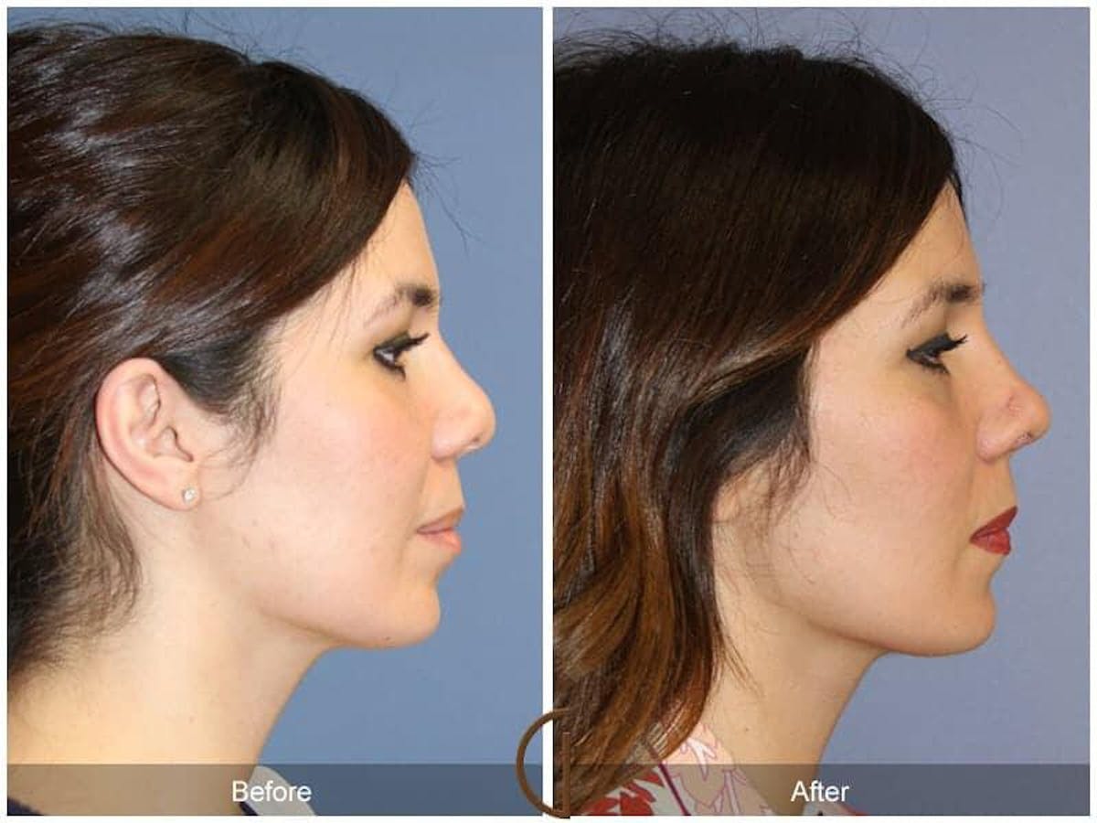 Revision Rhinoplasty Before & After Gallery - Patient 358623 - Image 3