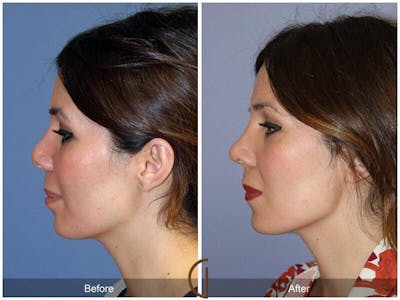 Revision Rhinoplasty Before & After Gallery - Patient 358623 - Image 1