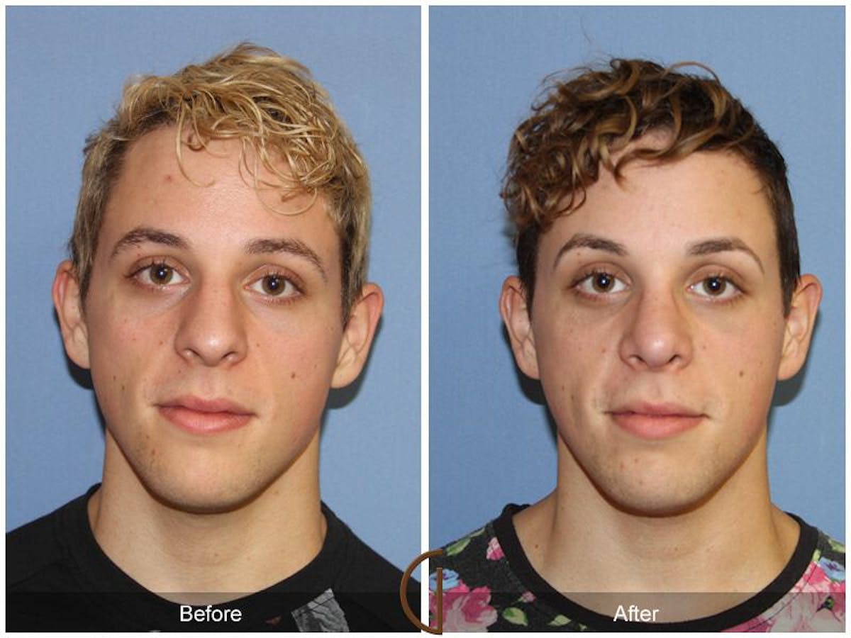 Rhinoplasty Before & After Gallery - Patient 694020 - Image 2