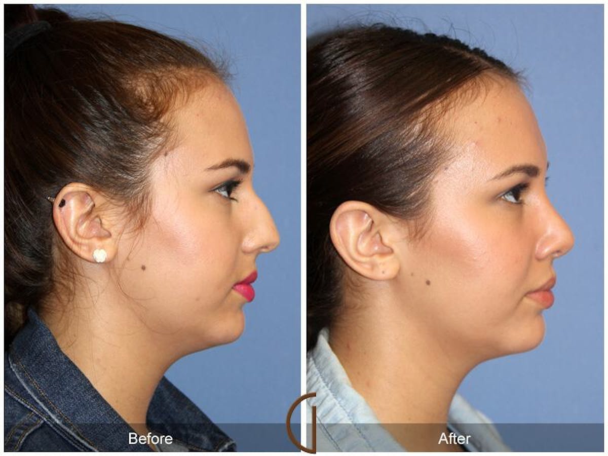 Female Rhinoplasty Before & After Gallery - Patient 328110 - Image 3