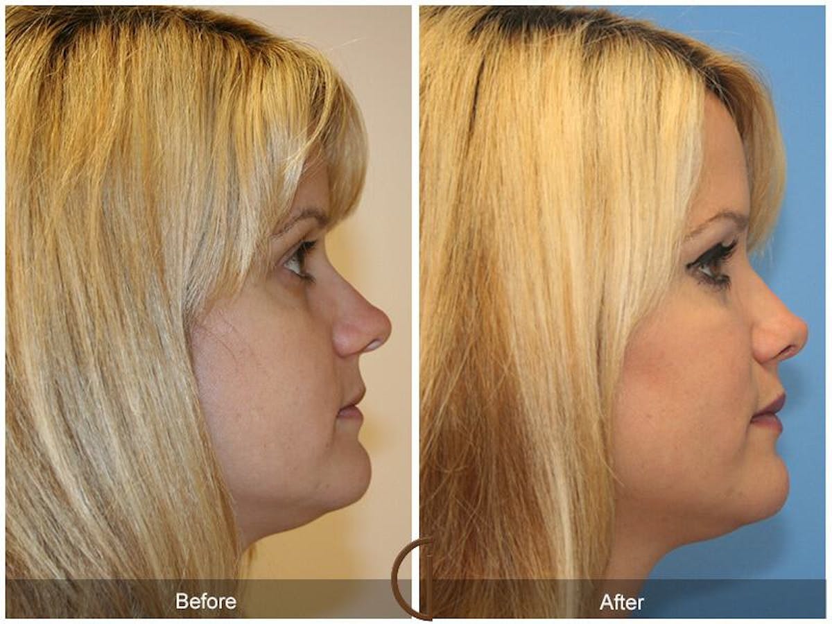 Female Rhinoplasty Before & After Gallery - Patient 425316 - Image 3